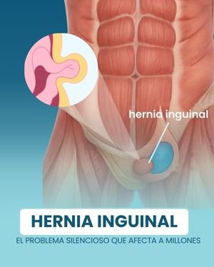 Lee más sobre el artículo HERNIA INGUINAL